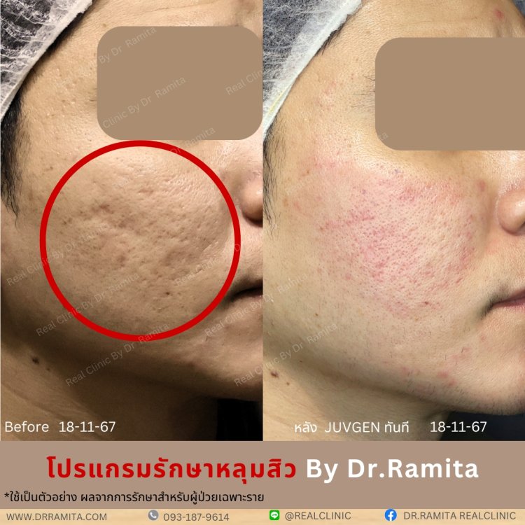 juvgen drjin ดร.จิน หลุมสิวเกาหลี รักษาหลุมสิว ศัลยกรรมหลุมสิว real scar synergy dr ramita  รีวิวหลุมสิว