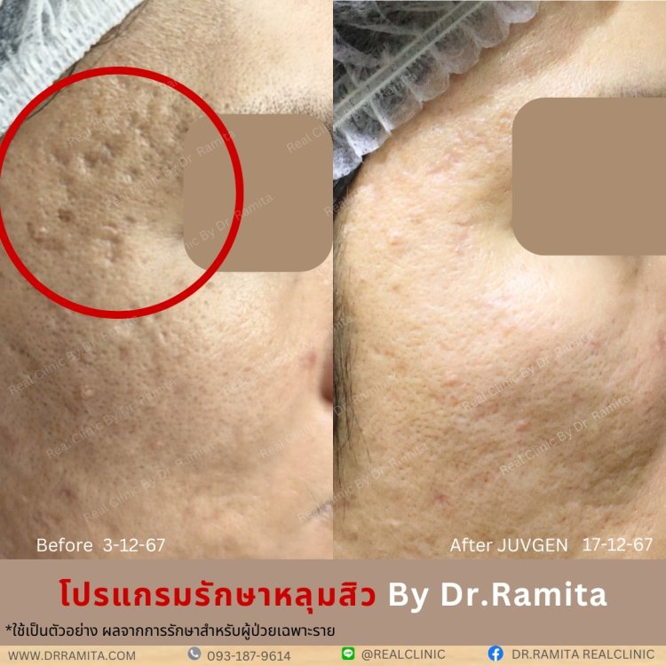 juvgen drjin ดร.จิน หลุมสิวเกาหลี รักษาหลุมสิว ศัลยกรรมหลุมสิว real scar synergy dr ramita  รีวิวหลุมสิว