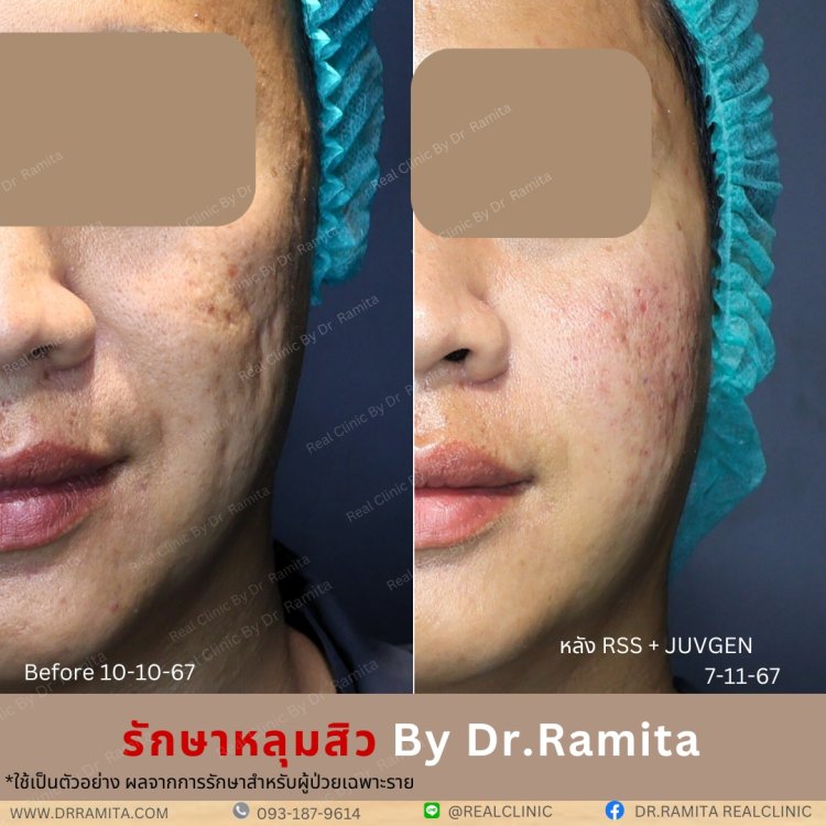 juvgen ดร.จิน หลุมสิวเกาหลี real scar synergy รักษาหลุมสิว