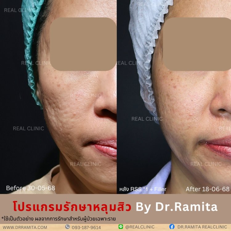 รักษาหลุมสิว