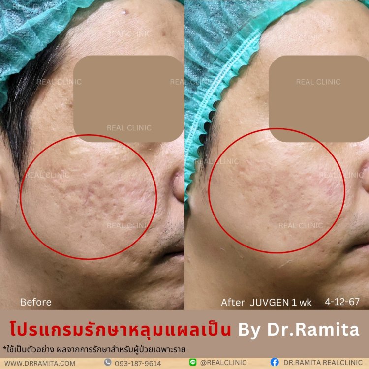 รักษาหลุมสิว,ตัดพังผืด,รักษาหลุมสิว, วิธีรักษาหลุมสิว, Subcision, เติมฟิลเลอร์, Real Scar Synergy, รักษาหลุมสิวที่ไหนดี,Juvgen,acnescarsurgery,acnescarrevision,รักษาหลุมสิวให้ตื้น,เลเซอร์หลุมสิว, รักษาหลุมสิวที่ดีที่สุด,รักษาหลุมสิวให้หายขาด,หลุมสิว,realc