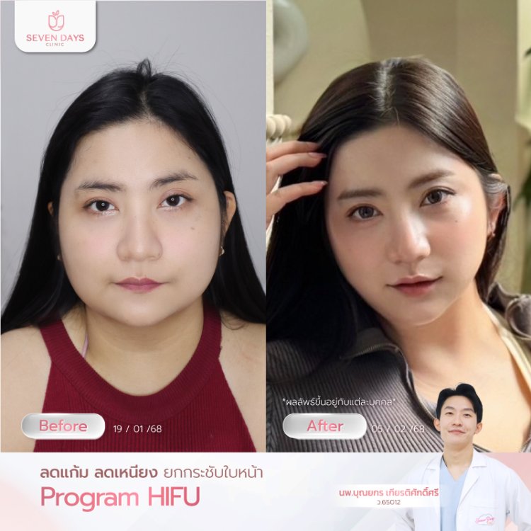 โปรแกรม Hifu