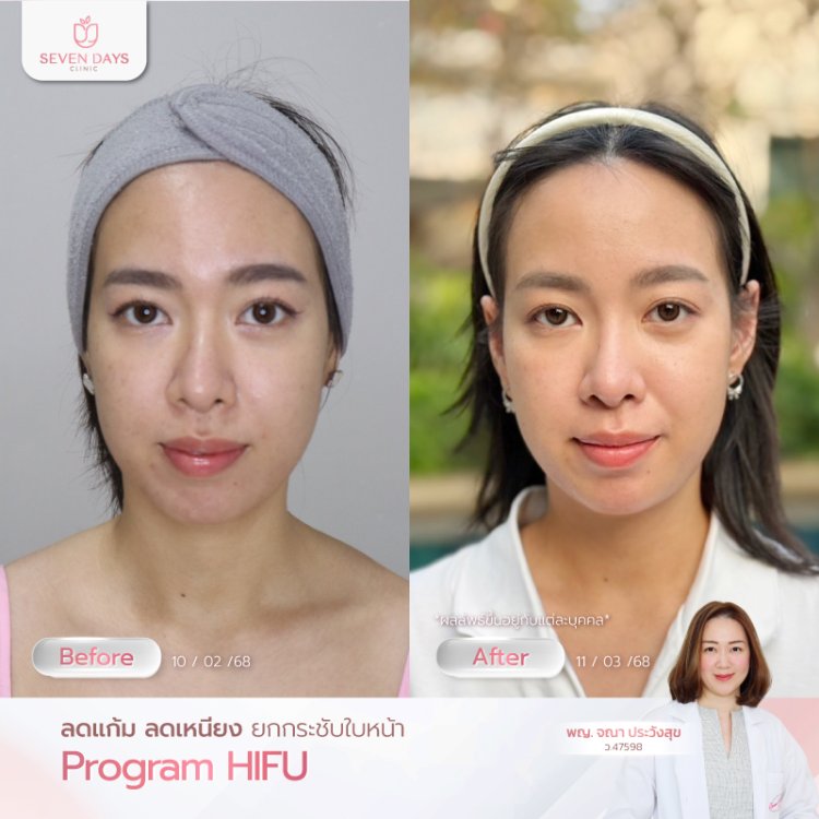 โปรแกรม Hifu