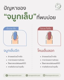 ปัญหาของ “จมูกเล็บ” ที่พบบ่อย