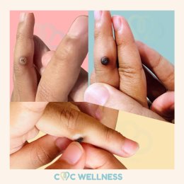 การรักษาหูดที่ผิวหนังด้วยความเย็น (Cryotherapy for Skin Warts)