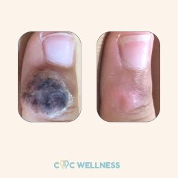 การรักษาหูดที่ผิวหนังด้วยความเย็น (Cryotherapy for Skin Warts)