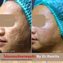 ฟิลเลอร์หลุมสิว: ทางเลือกใหม่ของคนเป็นหลุมสิว เพื่อผิวเรียบเนียน 2025