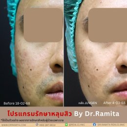 ฟิลเลอร์หลุมสิว: ทางเลือกใหม่ของคนเป็นหลุมสิว เพื่อผิวเรียบเนียน 2025