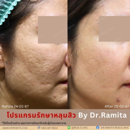 juvgen ดร.จิน หลุมสิวเกาหลี real scar synergy รักษาหลุมสิว