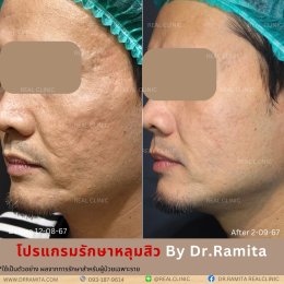 ฟิลเลอร์หลุมสิว: ทางเลือกใหม่ของคนเป็นหลุมสิว เพื่อผิวเรียบเนียน 2025