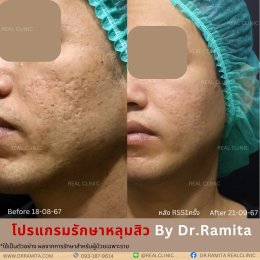 ฟิลเลอร์หลุมสิว: ทางเลือกใหม่ของคนเป็นหลุมสิว เพื่อผิวเรียบเนียน 2025