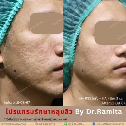 ฟิลเลอร์หลุมสิว: ทางเลือกใหม่ของคนเป็นหลุมสิว เพื่อผิวเรียบเนียน 2025