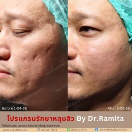 juvgen dr.jin  หลุมสิวเกาหลี ดร.จิน รักษาหลุมสิว ศัลยกรรมหลุมสิว ฟื้นฟูหลุมสิว real scar synergy dr.ramita real clinic 