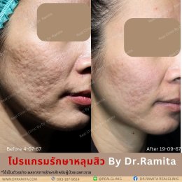 ฟิลเลอร์หลุมสิว: ทางเลือกใหม่ของคนเป็นหลุมสิว เพื่อผิวเรียบเนียน 2025