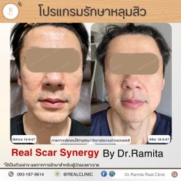 juvgen หลุมสิวเกาหลี real scar synergy รักษาหลุมสิว