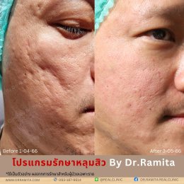 juvgen dr.jin  หลุมสิวเกาหลี ดร.จิน รักษาหลุมสิว ศัลยกรรมหลุมสิว ฟื้นฟูหลุมสิว real scar synergy dr.ramita real clinic 