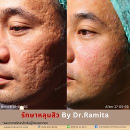ฟิลเลอร์หลุมสิว: ทางเลือกใหม่ของคนเป็นหลุมสิว เพื่อผิวเรียบเนียน 2025