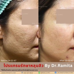 JUVGEN คืออะไร รักษาหลุมสิวได้อย่างไร ดร.จินเกาหลี รักษาหลุมสิวเกาหลี 