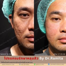 juvgen ดร.จิน หลุมสิวเกาหลี real scar synergy รักษาหลุมสิว