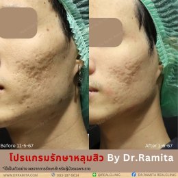 ฟิลเลอร์หลุมสิว: ทางเลือกใหม่ของคนเป็นหลุมสิว เพื่อผิวเรียบเนียน 2025