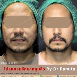 ฟิลเลอร์หลุมสิว: ทางเลือกใหม่ของคนเป็นหลุมสิว เพื่อผิวเรียบเนียน 2025