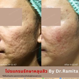 ฟิลเลอร์หลุมสิว: ทางเลือกใหม่ของคนเป็นหลุมสิว เพื่อผิวเรียบเนียน 2025