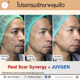 JUVGEN คืออะไร รักษาหลุมสิวได้อย่างไร ดร.จินเกาหลี รักษาหลุมสิวเกาหลี 