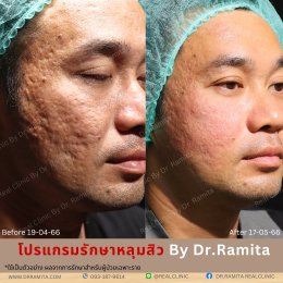 juvgen dr.jin  หลุมสิวเกาหลี ดร.จิน รักษาหลุมสิว ศัลยกรรมหลุมสิว ฟื้นฟูหลุมสิว real scar synergy dr.ramita real clinic 