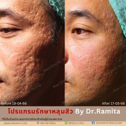 juvgen dr.jin  หลุมสิวเกาหลี ดร.จิน รักษาหลุมสิว ศัลยกรรมหลุมสิว ฟื้นฟูหลุมสิว real scar synergy dr.ramita real clinic 