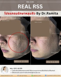 JUVGEN คืออะไร รักษาหลุมสิวได้อย่างไร ดร.จินเกาหลี รักษาหลุมสิวเกาหลี 