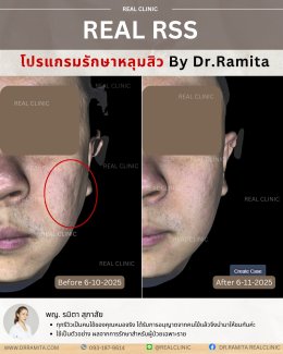 JUVGEN คืออะไร รักษาหลุมสิวได้อย่างไร ดร.จินเกาหลี รักษาหลุมสิวเกาหลี 