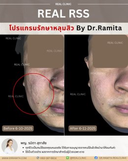 JUVGEN คืออะไร รักษาหลุมสิวได้อย่างไร ดร.จินเกาหลี รักษาหลุมสิวเกาหลี 