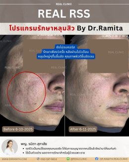 JUVGEN คืออะไร รักษาหลุมสิวได้อย่างไร ดร.จินเกาหลี รักษาหลุมสิวเกาหลี 