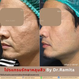 JUVGEN คืออะไร รักษาหลุมสิวได้อย่างไร ดร.จินเกาหลี รักษาหลุมสิวเกาหลี 