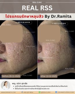 JUVGEN คืออะไร รักษาหลุมสิวได้อย่างไร ดร.จินเกาหลี รักษาหลุมสิวเกาหลี 