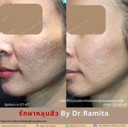 ทำ JUVGEN กับ Dr.Ramita RealClinic พิเศษอย่างไร?