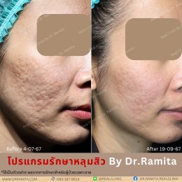 JUVGEN คืออะไร รักษาหลุมสิวได้อย่างไร ดร.จินเกาหลี รักษาหลุมสิวเกาหลี 