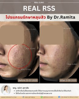 JUVGEN คืออะไร รักษาหลุมสิวได้อย่างไร ดร.จินเกาหลี รักษาหลุมสิวเกาหลี 