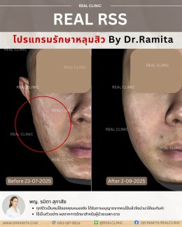JUVGEN คืออะไร รักษาหลุมสิวได้อย่างไร ดร.จินเกาหลี รักษาหลุมสิวเกาหลี 