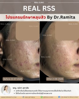 JUVGEN คืออะไร รักษาหลุมสิวได้อย่างไร ดร.จินเกาหลี รักษาหลุมสิวเกาหลี 