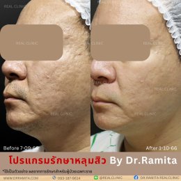 ทำ JUVGEN กับ Dr.Ramita RealClinic พิเศษอย่างไร?
