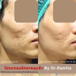 ฟิลเลอร์หลุมสิว: ทางเลือกใหม่ของคนเป็นหลุมสิว เพื่อผิวเรียบเนียน 2025