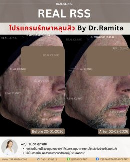 JUVGEN คืออะไร รักษาหลุมสิวได้อย่างไร ดร.จินเกาหลี รักษาหลุมสิวเกาหลี 