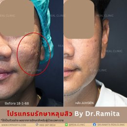 JUVGEN คืออะไร รักษาหลุมสิวได้อย่างไร ดร.จินเกาหลี รักษาหลุมสิวเกาหลี 