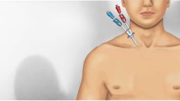 สายฟอกไตชั่วคราว(DLC) คืออะไร? 