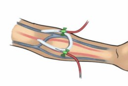 ทำความรู้จักเส้นฟอกไต (Vascular Access) 