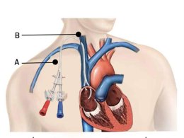 ทำความรู้จักเส้นฟอกไต (Vascular Access) 
