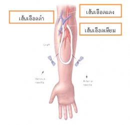 ข้อปฎิบัติตัวสำหรับผู้ป่วยระยะหลังผ่าตัด ที่ทําการตัดต่อเส้นเลือดที่แขน