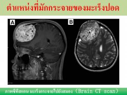 มะเร็งปอด โรคภัยใกล้ตัว ป้องกันดูแลรักษาด้วยวิธีแพทย์จีน