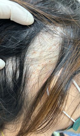 Treatment of Alopecia Areata (Patchy Hair Loss) with Chinese Herbal Medicine: A Case Report
